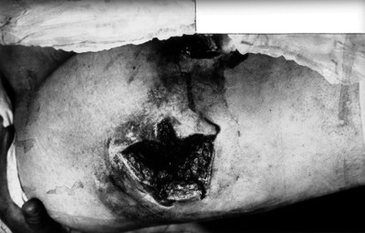 Pierna de un cadáver herida de bala